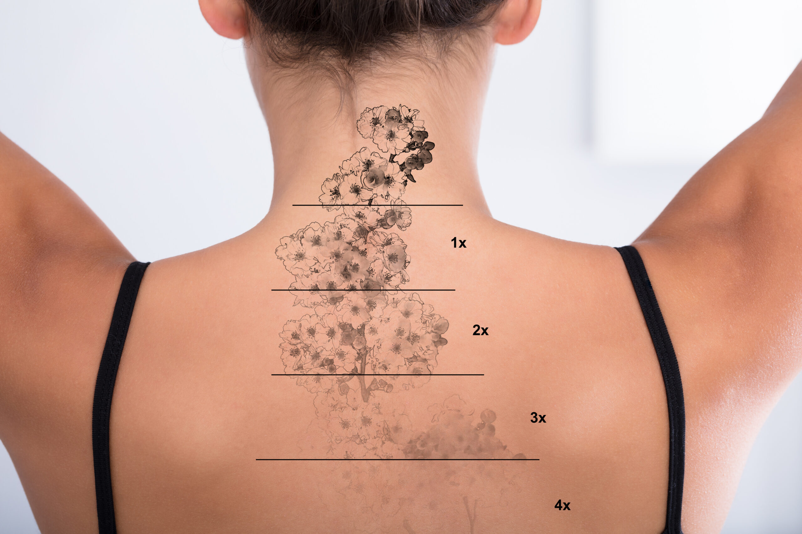 Tattoo Removal On Woman’s Back