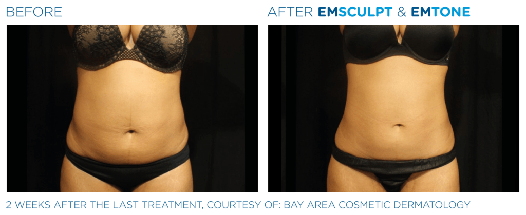 Emsculpt_Emtone_PIC_Ba-card-female-abdomen-002_EN100