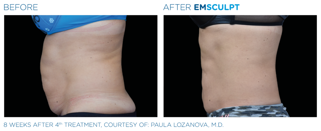 Emsculpt_PIC_Ba-card-female-abdomen-022_EN100