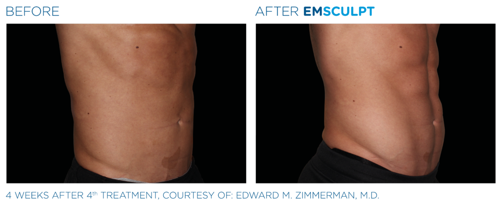 Emsculpt_PIC_Ba-card-male-abdomen-036_ENUS100