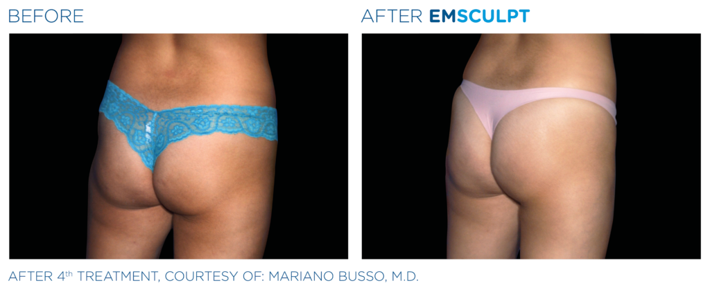 Emsculpt_PIC_Ba-card-female-buttock-012_EN100