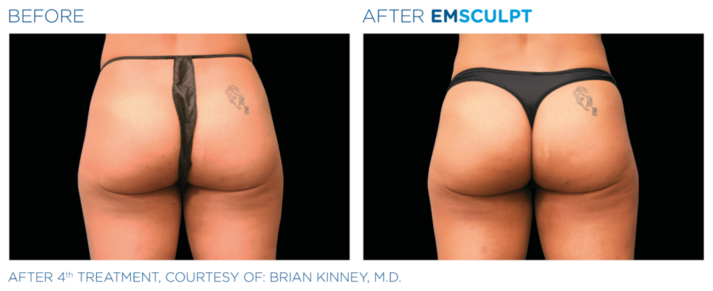 Emsculpt_PIC_Ba-card-female-buttock-014_EN100